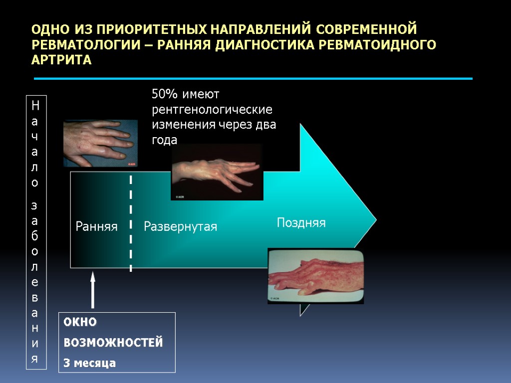 ОДНО ИЗ ПРИОРИТЕТНЫХ НАПРАВЛЕНИЙ СОВРЕМЕННОЙ РЕВМАТОЛОГИИ – РАННЯЯ ДИАГНОСТИКА РЕВМАТОИДНОГО АРТРИТА Начало заболевания Ранняя